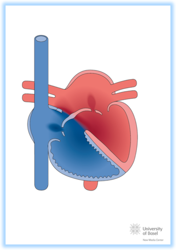 Imagen de Defecto atrioventricular completo Imagen de Defecto atrioventricular completo